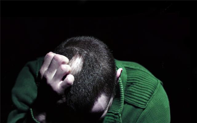 Tratamiento actual de la alopecia areata