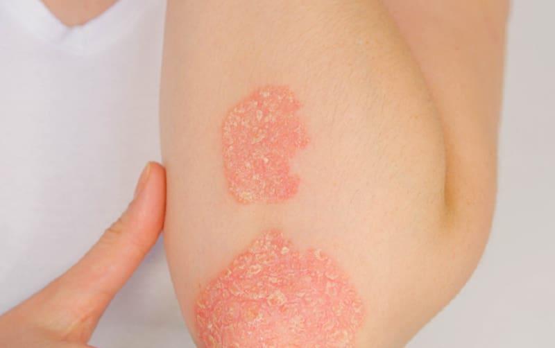 Psoriasis
