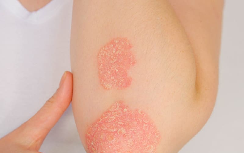 Psoriasis